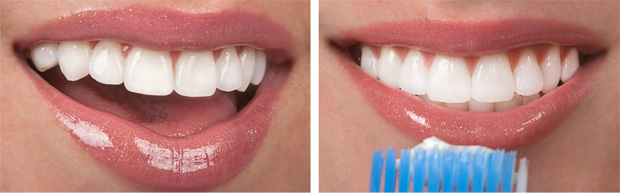 oral hygiene roseville sydney Brushing to save your teeth for life